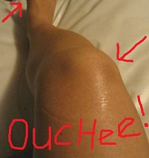 Nail extracted from foot and hammer sized bruise on knee